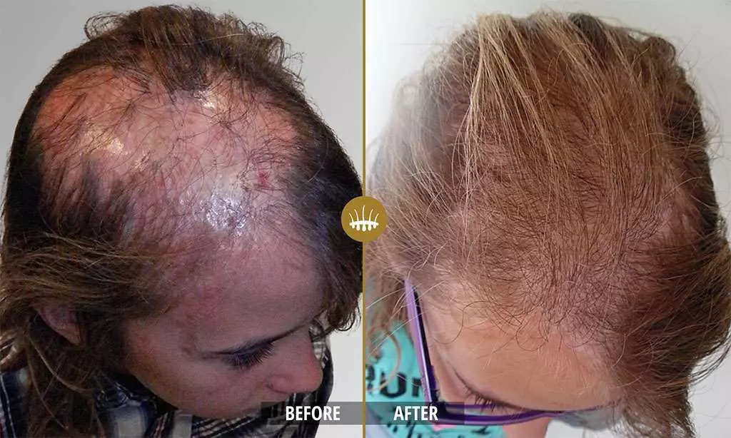 Hair restoration result 20
